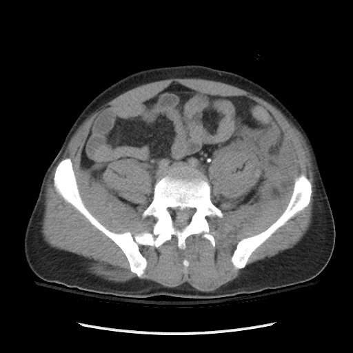 Blunt abdominal trauma with solid organ and musculoskelatal injury with active extravasation (Radiopaedia 68364-77895 Axial C+ delayed 98).jpg