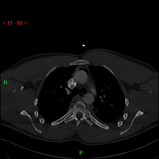Blunt thoracic trauma (Radiopaedia 73454-84221 Axial bone window 36).jpg