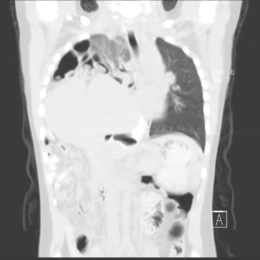 File:Bochdalek diaphragmatic hernia (Radiopaedia 38866-41059 Coronal lung window 11).jpg