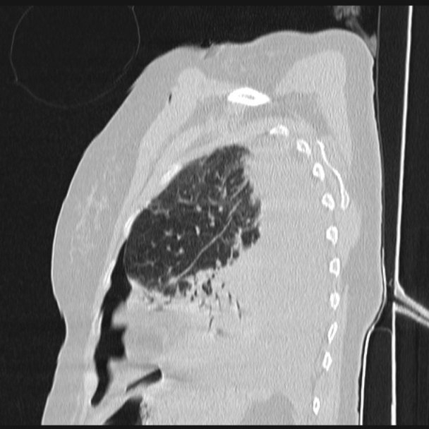 Boerhaave syndrome (Radiopaedia 45644-49799 Sagittal lung window 67).jpg