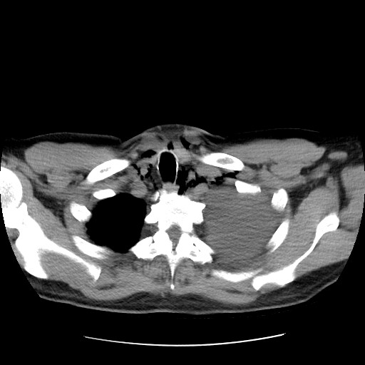 Boerhaave syndrome (Radiopaedia 59796-67310 Axial liver window 11).jpg