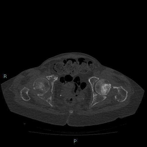 Bone metastases from untreated breast cancer (Radiopaedia 42973-46219 Axial bone window 184).jpg