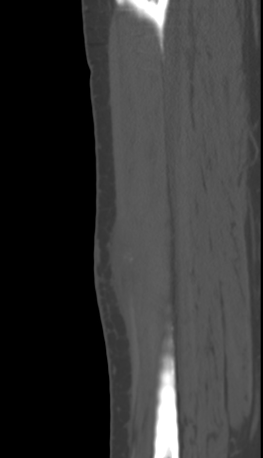 Bone metastasis - tibia (Radiopaedia 57665-64609 Sagittal bone window 119).jpg