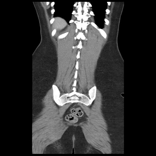 Borderline mucinous tumor (ovary) (Radiopaedia 78228-90808 C 42).jpg