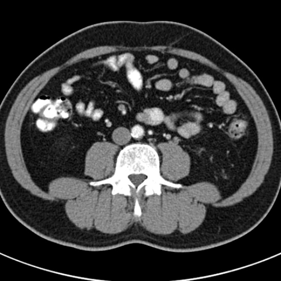 File:Bosniak cyst - type IV (Radiopaedia 23525-23627 renal cortical phase 47).jpg