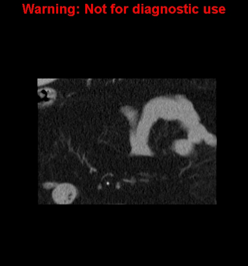 File:Bosniak renal cyst - type IV (Radiopaedia 23402-23466 C 6).jpg