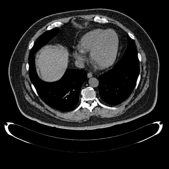 Bosniak renal cyst - type IV (Radiopaedia 24244-24518 Axial non-contrast 17).jpg