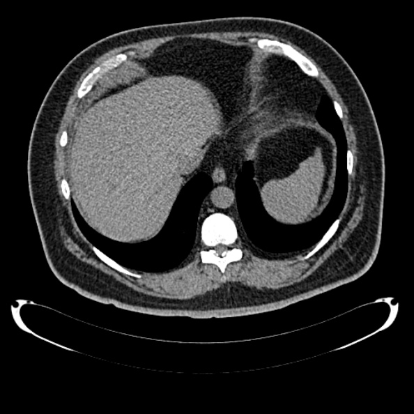 Bosniak renal cyst - type IV (Radiopaedia 24244-24518 Axial non-contrast 50).jpg