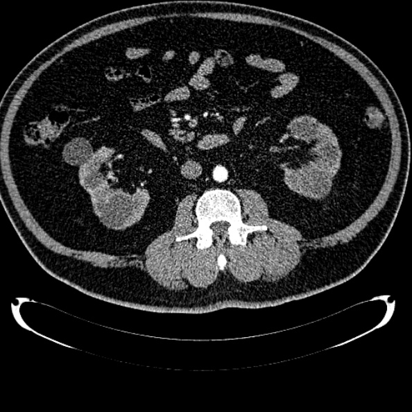 File:Bosniak renal cyst - type IV (Radiopaedia 24244-24518 B 174).jpg