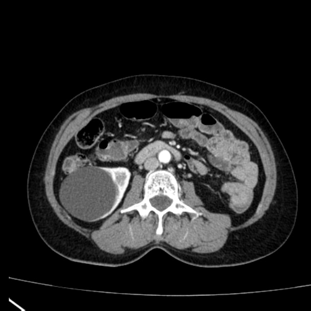 Bosniak renal cyst - type I (Radiopaedia 27479-27675 renal cortical phase 42).jpg