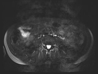 File:Bouveret syndrome (Radiopaedia 61017-68856 Axial MRCP 48).jpg