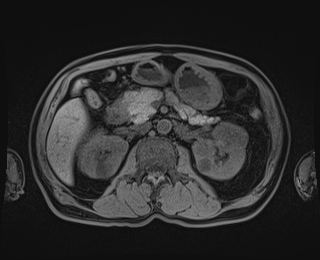 Bouveret syndrome (Radiopaedia 61017-68856 Axial T1 fat sat 39).jpg