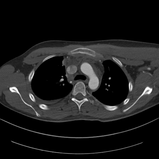 Brachiocephalic trunk pseudoaneurysm (Radiopaedia 70978-81191 Axial bone window 66).jpg