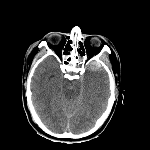 File:Brain contusions, internal carotid artery dissection and base of skull fracture (Radiopaedia 34089-35339 Axial non-contrast 25).png