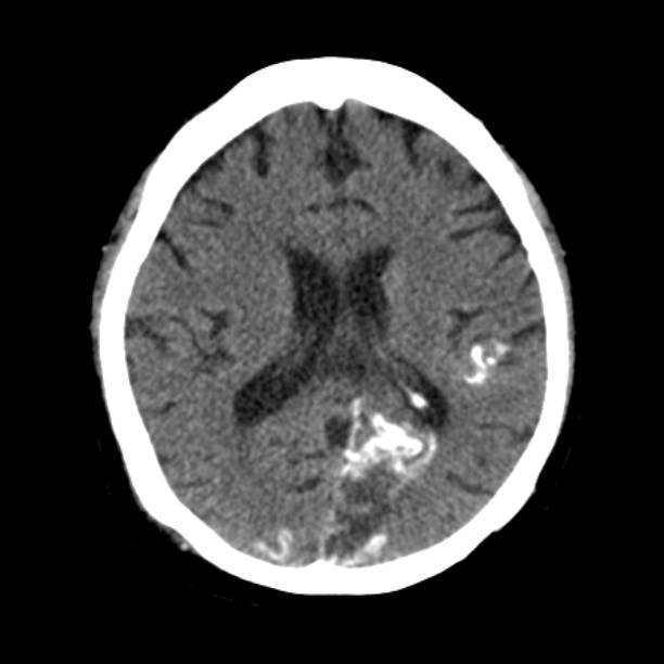 Brain cortical laminar necrosis (Radiopaedia 25822-25971 Axial non-contrast 26).jpg