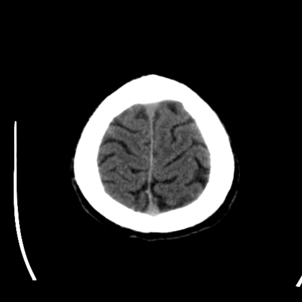 Brain metastases from lung cancer (Radiopaedia 24480-24781 Axial non-contrast 46).jpg