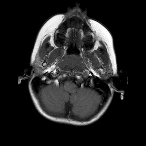 File:Brainstem ganglioglioma (Radiopaedia 10763-11224 Axial T1 17).jpg