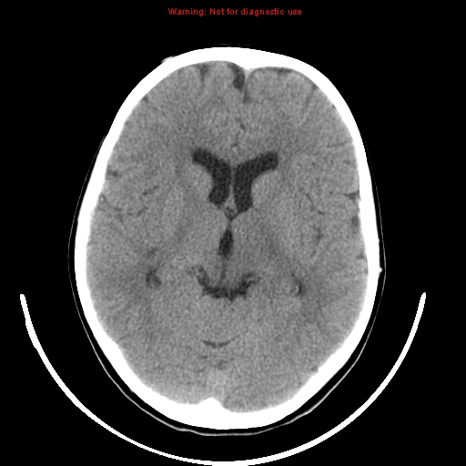 File:Brainstem glioma (Radiopaedia 9444-10123 non-contrast 11).jpg