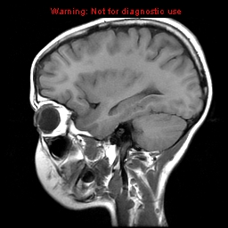 File:Brainstem glioma (Radiopaedia 9444-10124 Sagittal T1 10).jpg