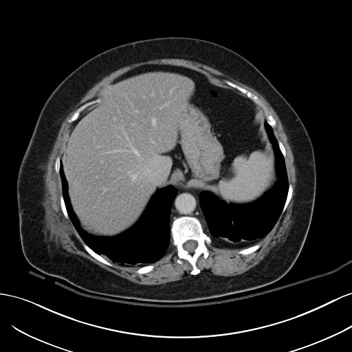 Breast carcinoma with pathological hip fracture (Radiopaedia 60314-67974 B 12).jpg