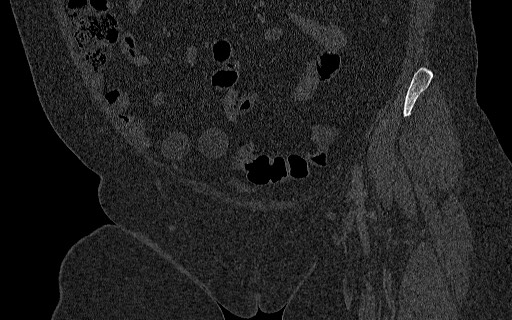 Breast carcinoma with pathological hip fracture (Radiopaedia 60314-67993 Coronal bone window 49).jpg