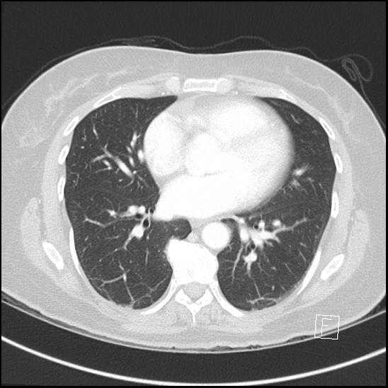 File:Breast metastases from renal cell cancer (Radiopaedia 79220-92225 Axial lung window 51).jpg