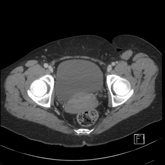 Breast metastases from renal cell cancer (Radiopaedia 79220-92225 C 111).jpg