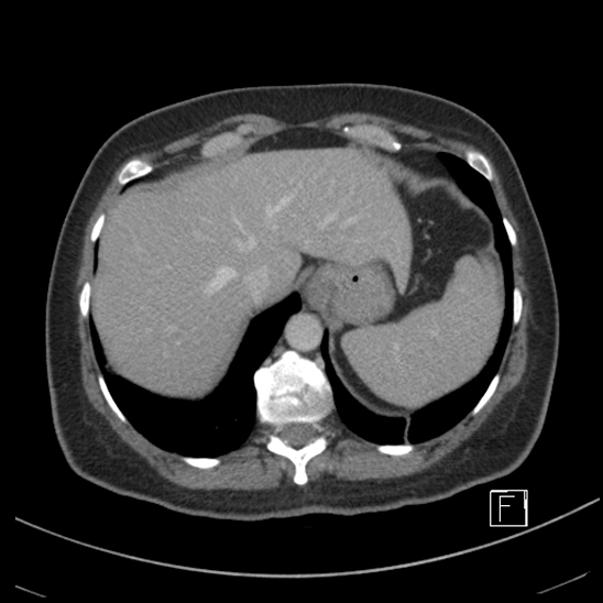 Breast metastases from renal cell cancer (Radiopaedia 79220-92225 C 13).jpg