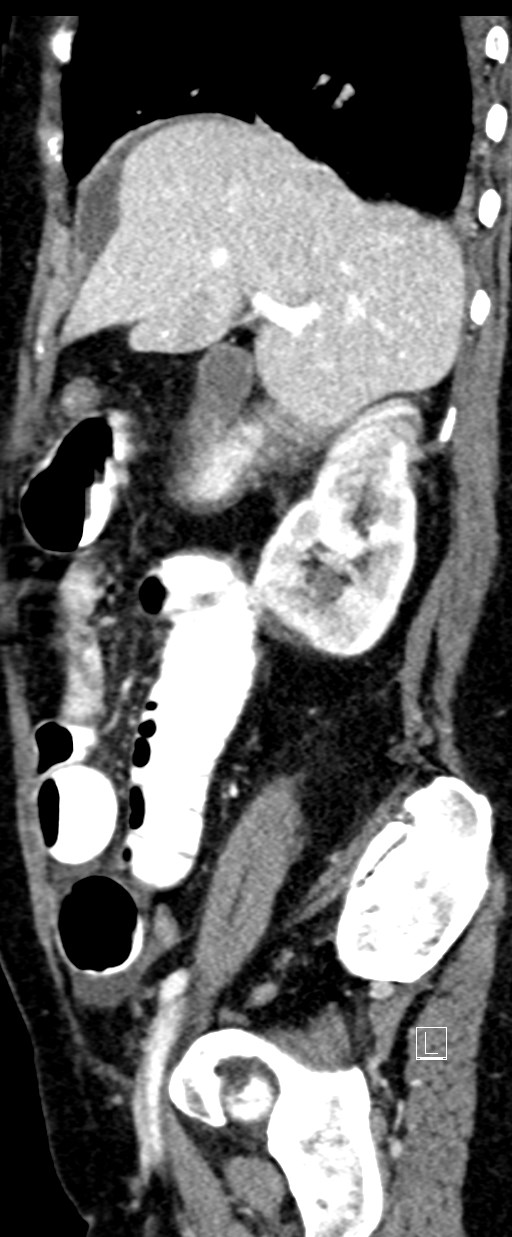 Broad ligament hernia (Radiopaedia 84802-100276 C 58).jpg