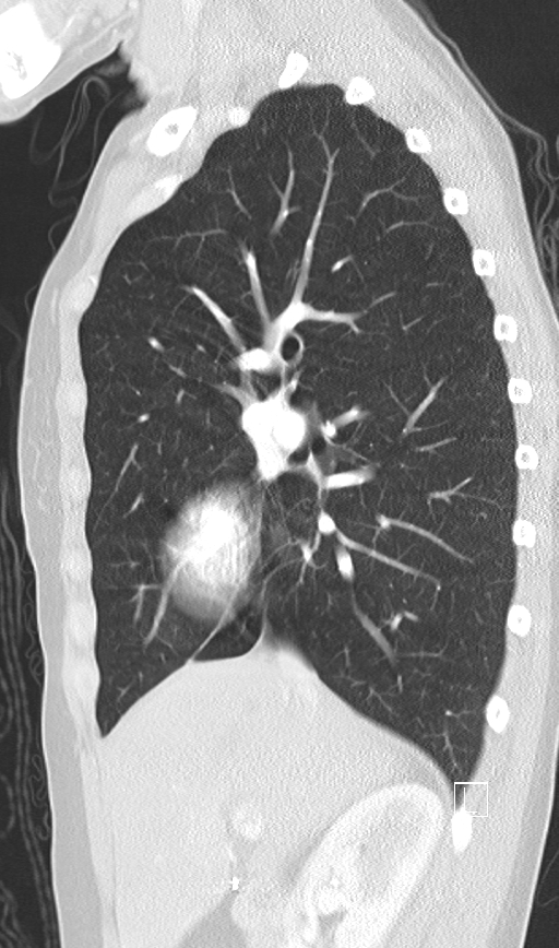 Bronchial atresia (Radiopaedia 73677-84470 Sagittal lung window 20).jpg