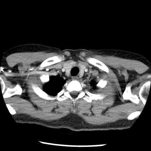 Bronchial carcinoid tumor (Radiopaedia 67377-76764 A 8).jpg