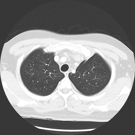 Bronchial carcinoid tumor (Radiopaedia 67377-76764 Axial lung window 16).jpg