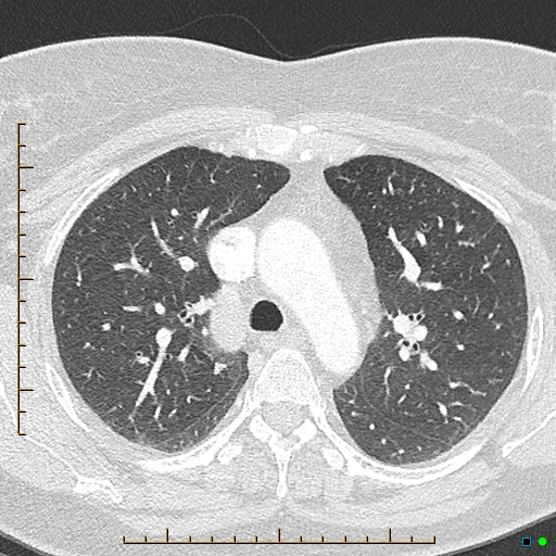 File:Bronchial diverticula (Radiopaedia 79512-92676 Axial lung window 58).jpg