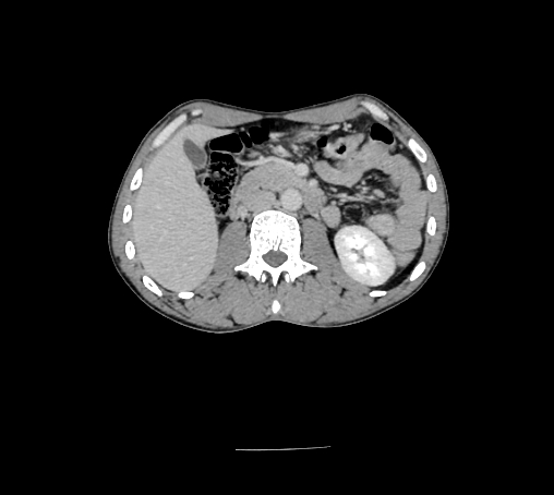 File:Bronchiectasis in Crohn disease (Radiopaedia 60311-67977 B 71).jpg