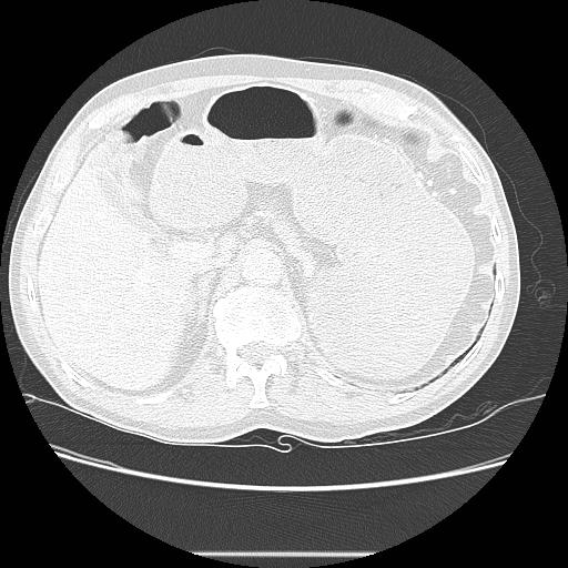 File:Bronchocele (Radiopaedia 17097-16795 Axial lung window 117).jpg