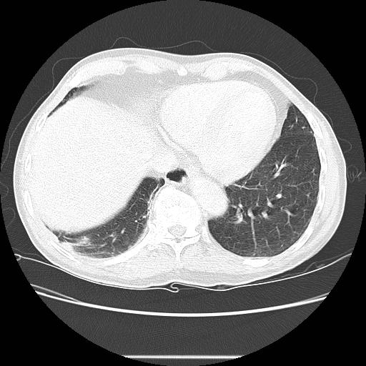 Bronchocele (Radiopaedia 17097-16795 Axial lung window 93).jpg