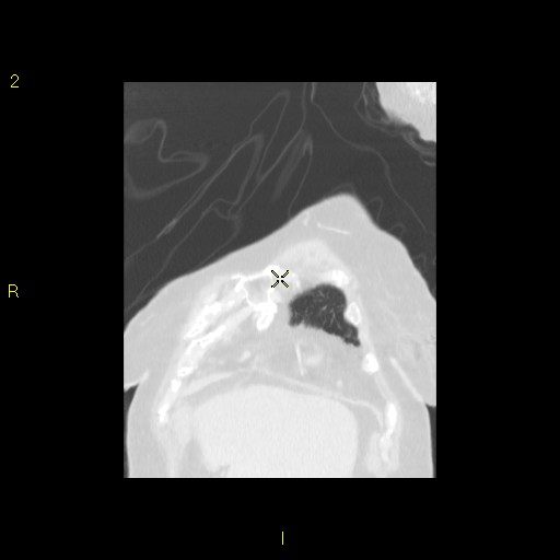 File:Bronchogenic carcinoma as an incidental finding (Radiopaedia 16453-16130 Coronal lung window 11).jpg