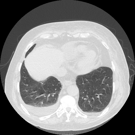Bronchogenic carcinoma with metastatic lymphadenopathy (Radiopaedia 37671-39569 Axial lung window 43).jpg