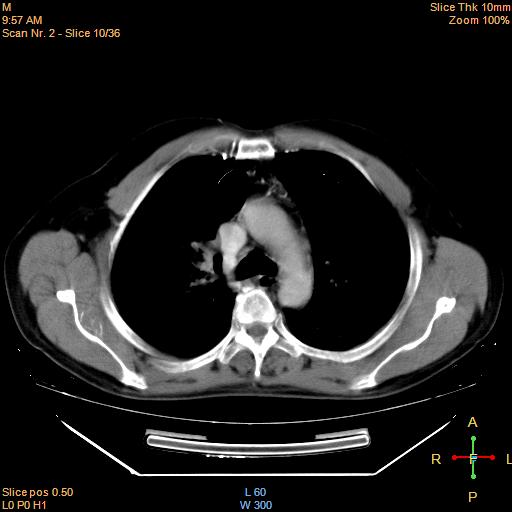 File:Bronchogenic carcinoma with superior vena caval invasion (Radiopaedia 22378-22406 Axial liver window 8).jpg