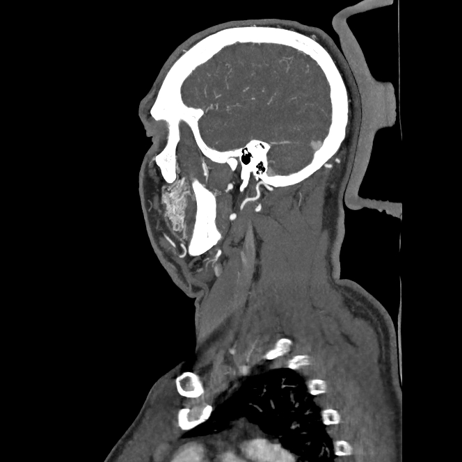 Buccal fat pad arteriovenous malformation (Radiopaedia 70936-81144 C 32).jpg