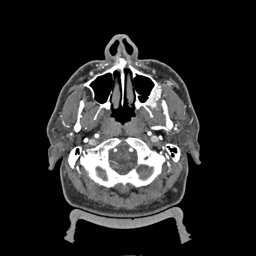Buccal fat pad arteriovenous malformation (Radiopaedia 70936-81144 D 227).jpg