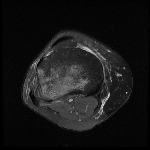 File:Bucket handle meniscus tear (Radiopaedia 56916-63751 Axial PD fat sat 16).jpg