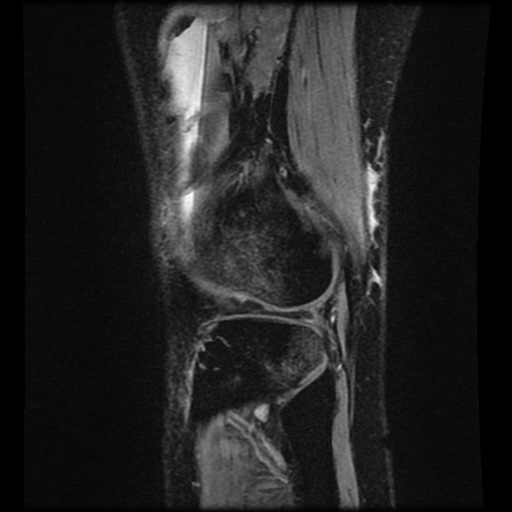 File:Bucket handle meniscus tear (Radiopaedia 56916-63751 H 11).jpg