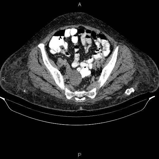 Budd-Chiari syndrome (Radiopaedia 63263-71837 C 39).jpg