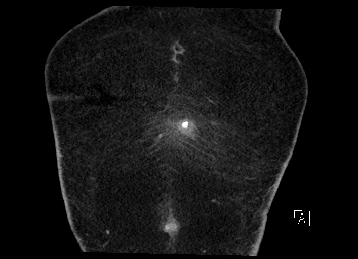 Buried bumper syndrome - gastrostomy tube (Radiopaedia 63843-72577 Coronal Inject 7).jpg