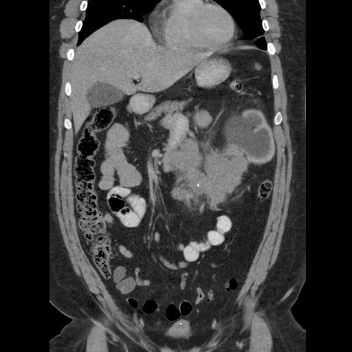 File:Burned-out testicular seminoma - retroperitoneal nodal metastases (Radiopaedia 62872-71245 B 26).jpg