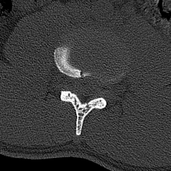 Burst fracture (Radiopaedia 53373-59357 Axial bone window 38).jpg