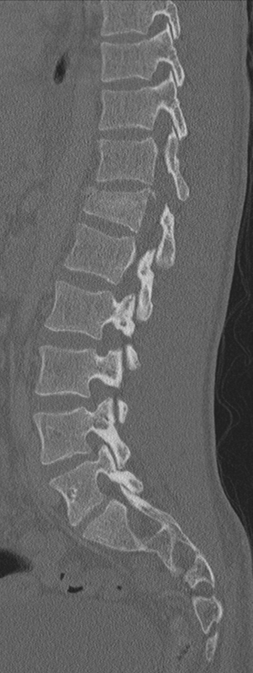 Burst fracture - T12 with conus compression (Radiopaedia 56825-63647 Sagittal bone window 34).png