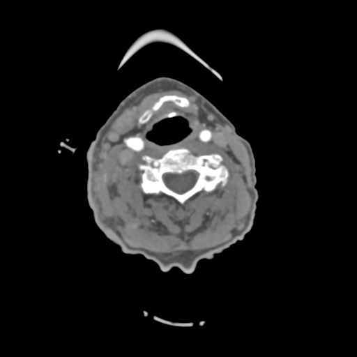 C2 fracture with vertebral artery dissection (Radiopaedia 37378-39200 A 133).png