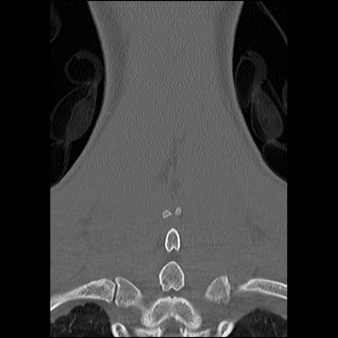 C5 facet fracture (Radiopaedia 58374-65499 Coronal bone window 52).jpg